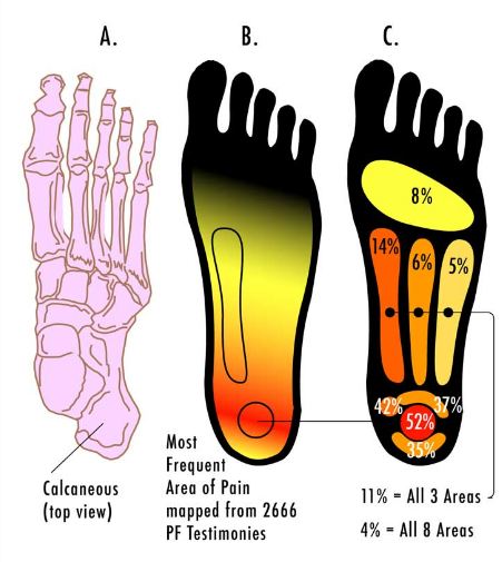 Most Common Areas of Pain.